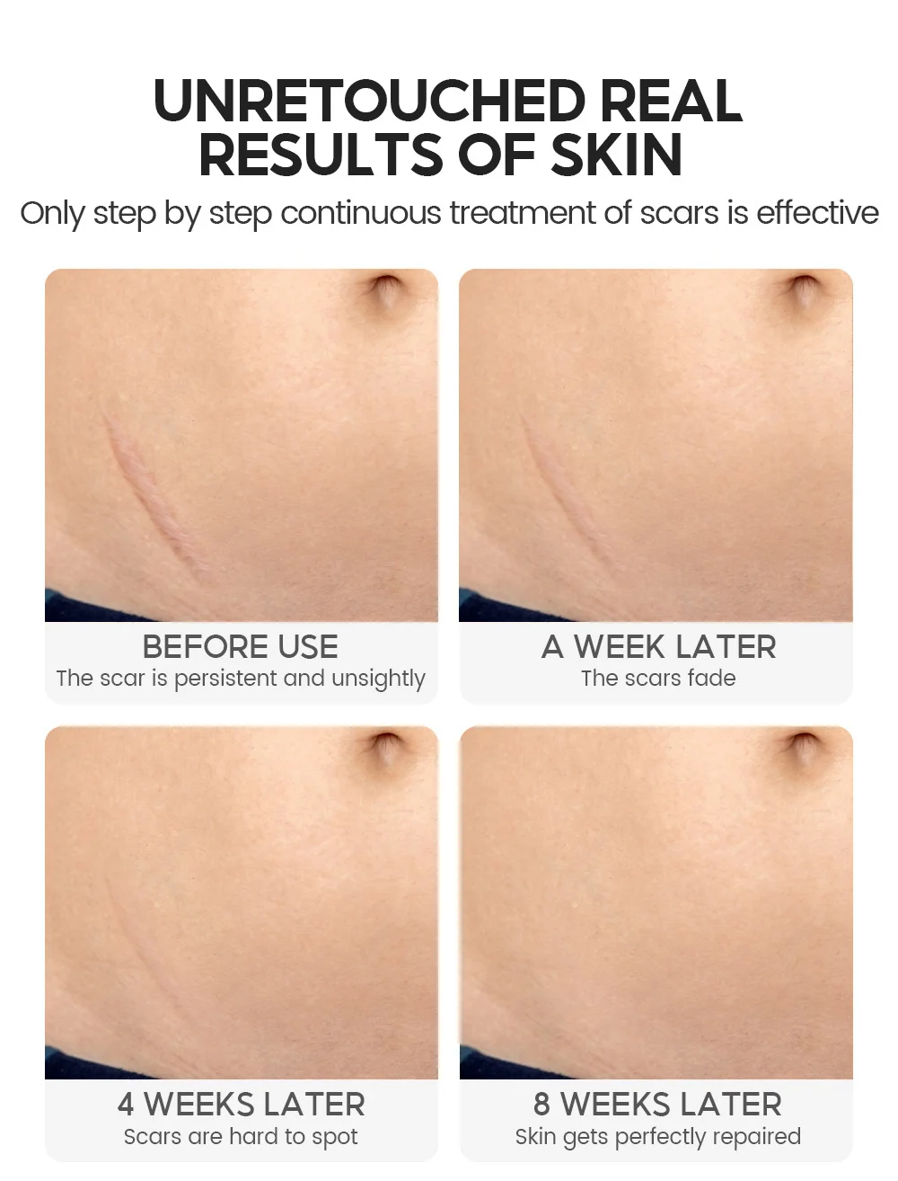 Cayman Repair Gel for Scar & Acne Mark Removal - VIBRANT GLAMOUR Anti-Inflammatory Skin Treatment (20g) 10 vibrant glamour cayman repair gel scar removal vib ct9tyjeg desc 10