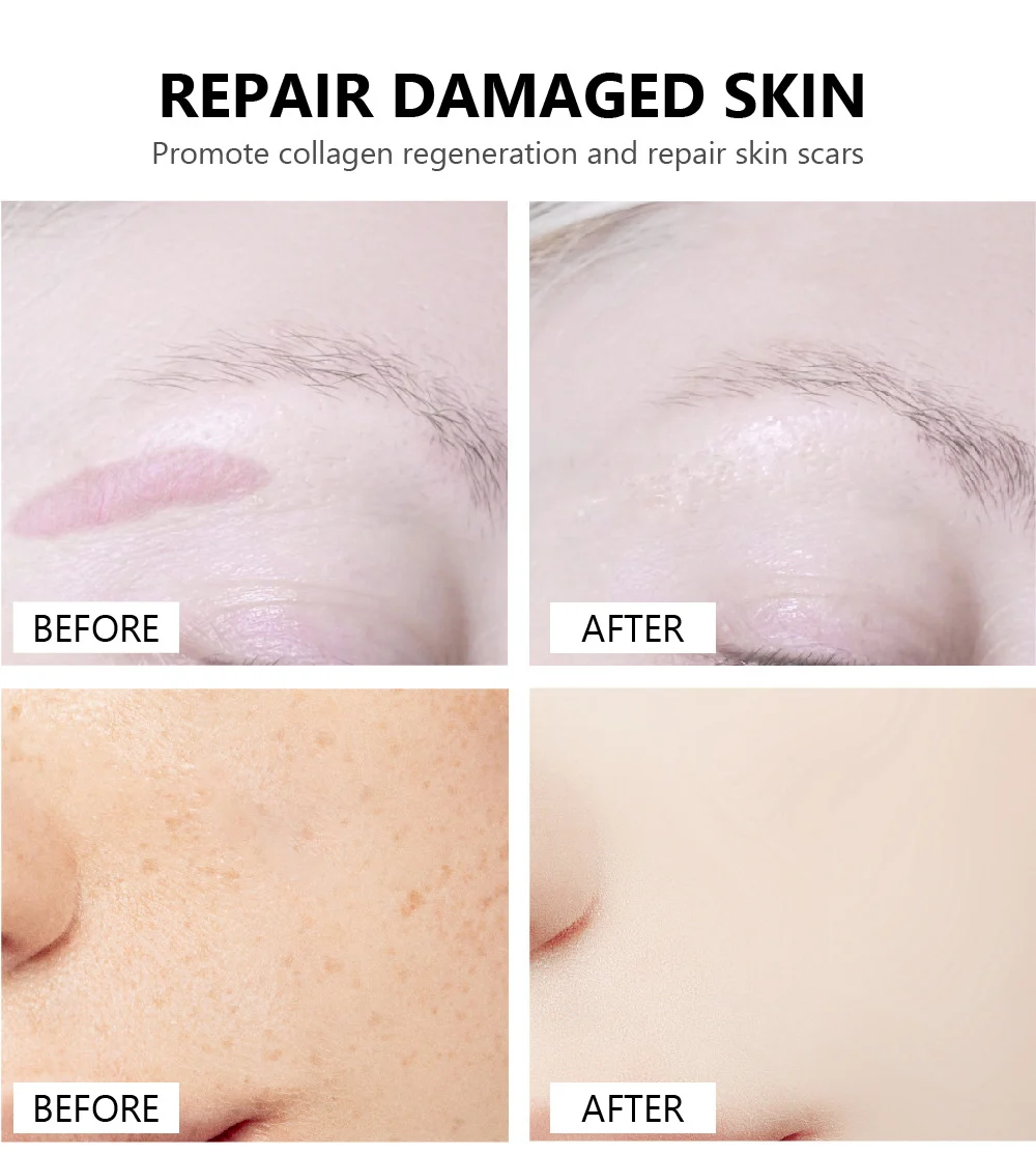 Crocodile Scar Removal Serum by VIBRANT GLAMOUR - 2nd Gen Acne Pit Repair & Pigment Reducer (30ml) 5 vibrant glamour crocodile scar removal serum 30ml vib ffyfaeuv desc 5